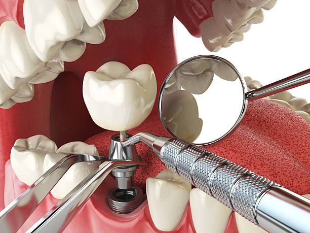Best Emergency Dentist for Lost Fillings or Crowns in Lakeview, GA